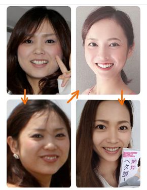 O脚矯正されたら歯軋りなくなって、小顔に。顎幅が細くなりました